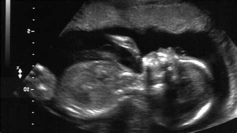 20 Week Ultrasound