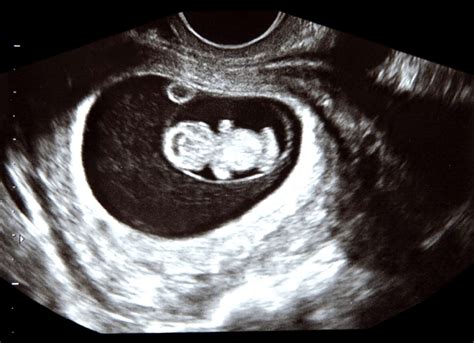 9 Weeks Ultrasound