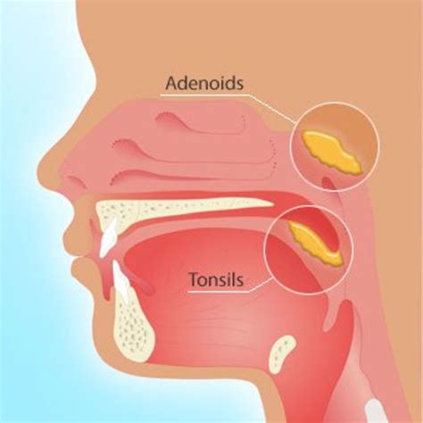 Adenoids Are Tonsils