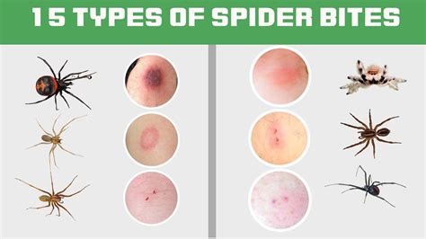 Are Bite Marks Dangerous