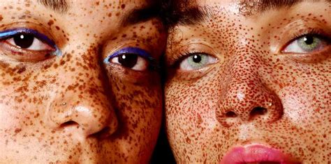 Are Freckles Genetic