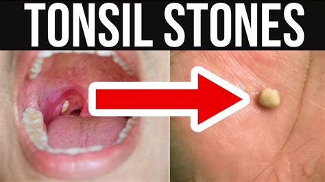 Are Throat Stones Dangerous