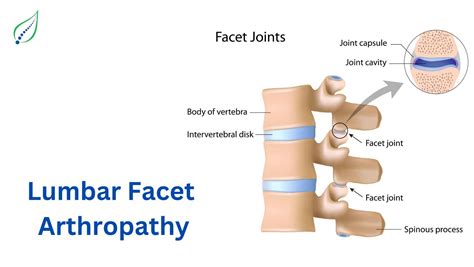Arthropathy Of Lumbar Facet Joint