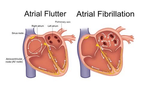 Atrial Fibrillation Vs Atrial Flutter