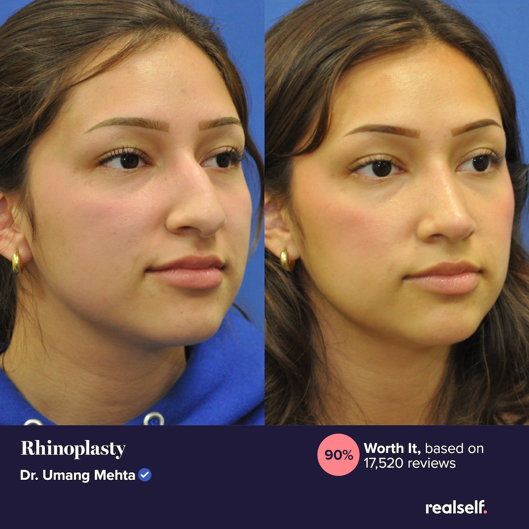 What Is The Average Cost Of Rhinoplasty In 2026?