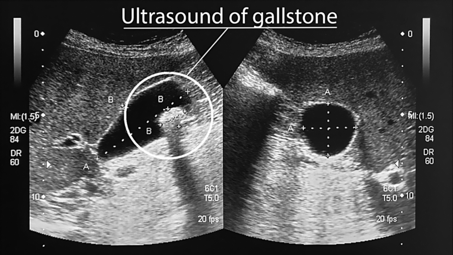 Understanding The Average Size Of Gallstones And What It Means