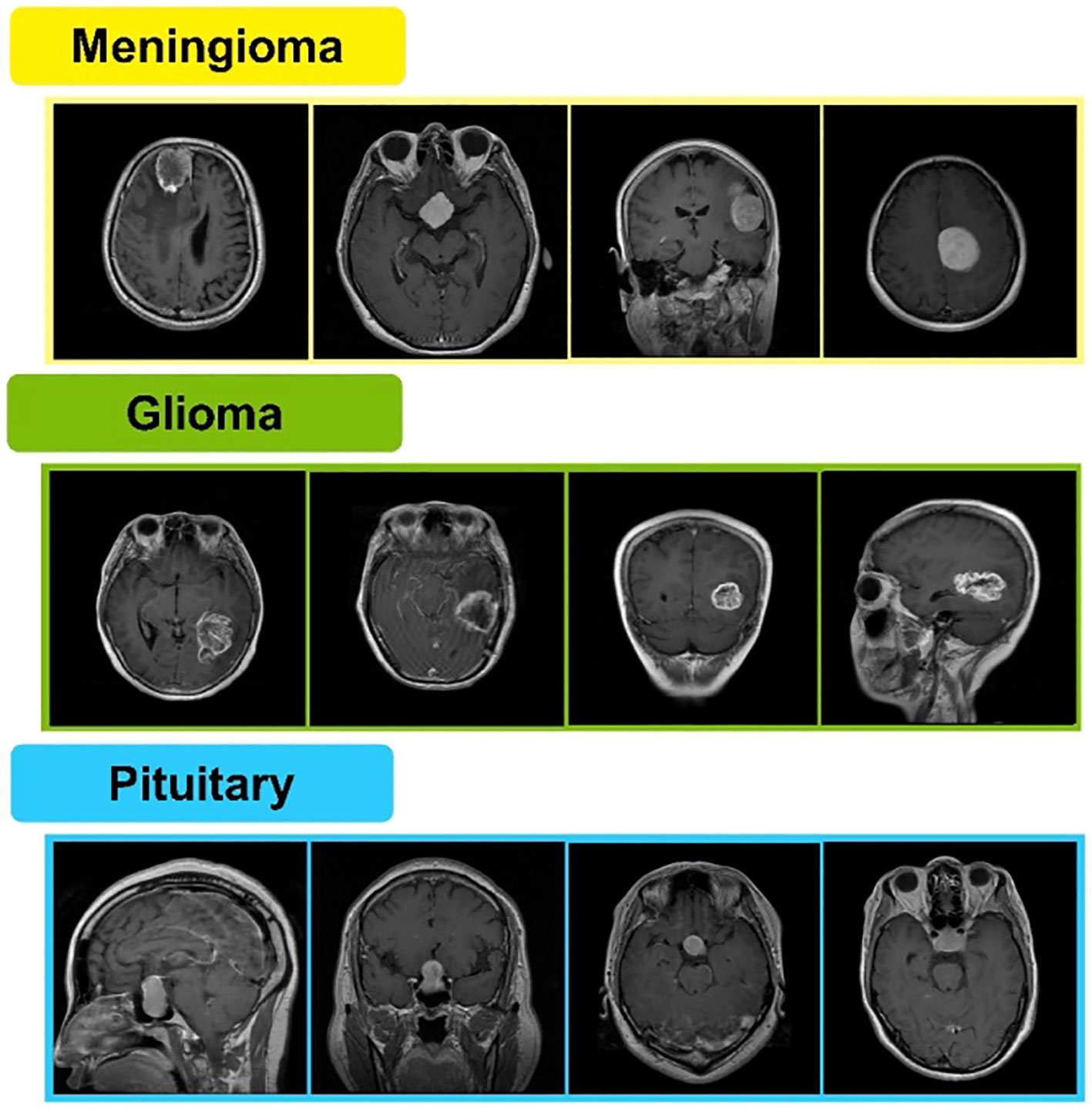 Understanding The Average Size Of Meningioma: What To Expect