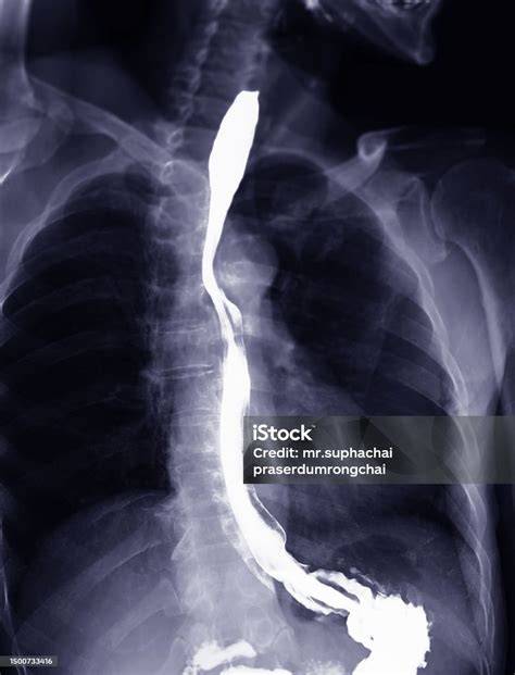 Barium Swallow Exam