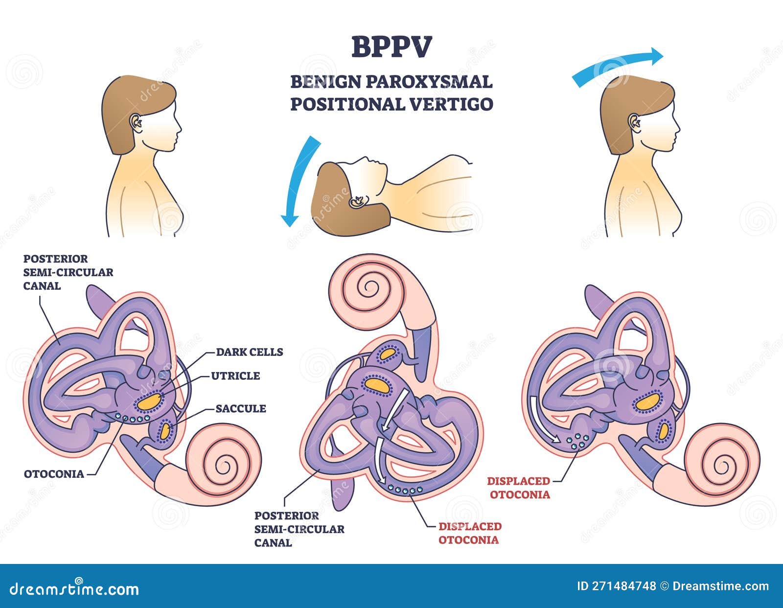 Benign Neoplasm Of Brain