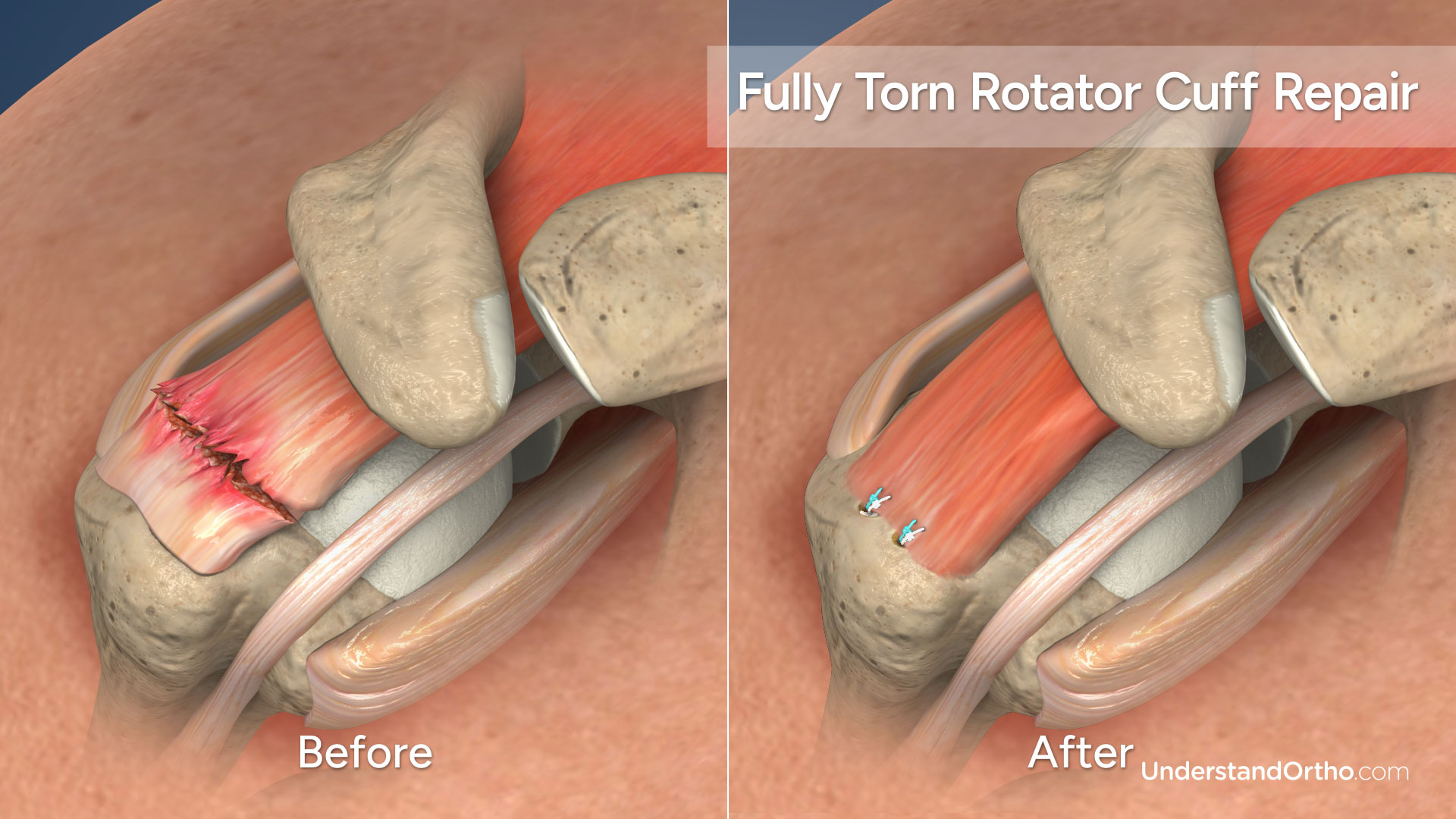 Finding The Best Job For Nerve Torn Recovery In 2026