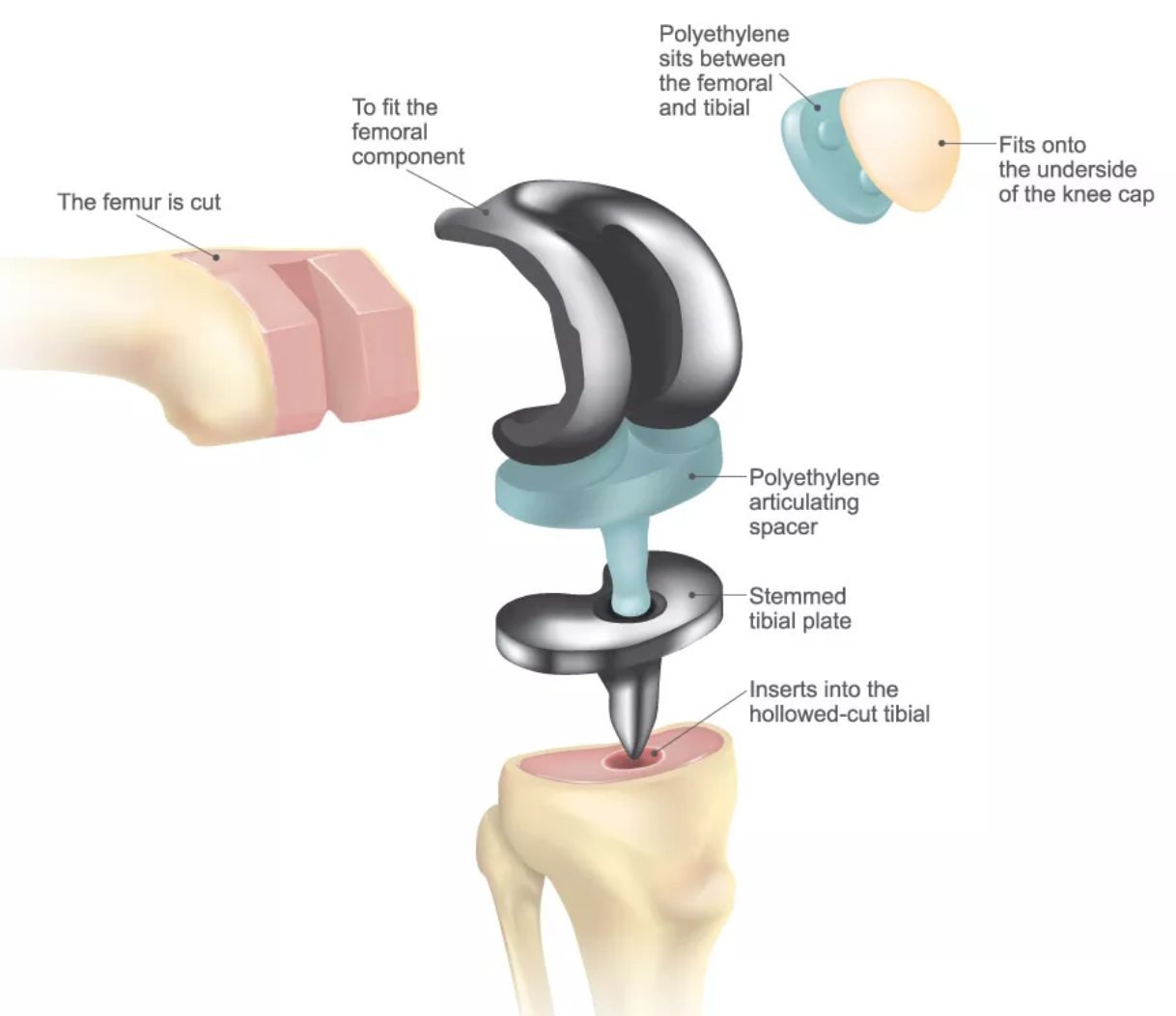 Choosing The Best Material For Knee Replacement: A Patient Guide