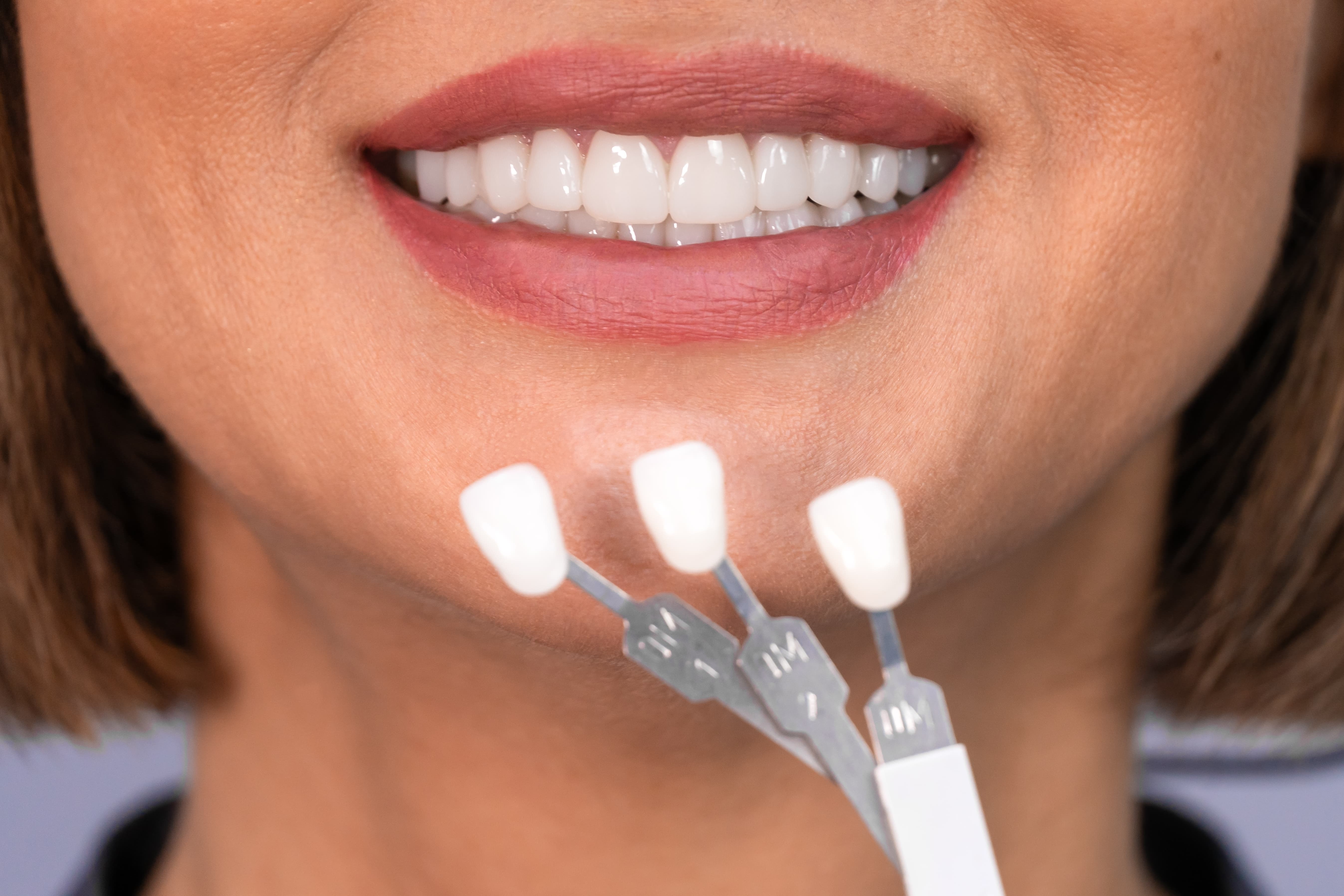 Choosing The Best Material For Veneers: A Patient’s Guide