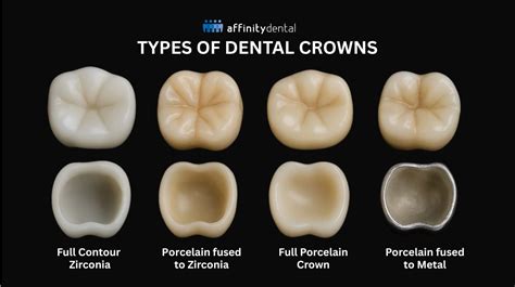 Choosing The Best Type Of Dental Crown For Your Smile In 2026