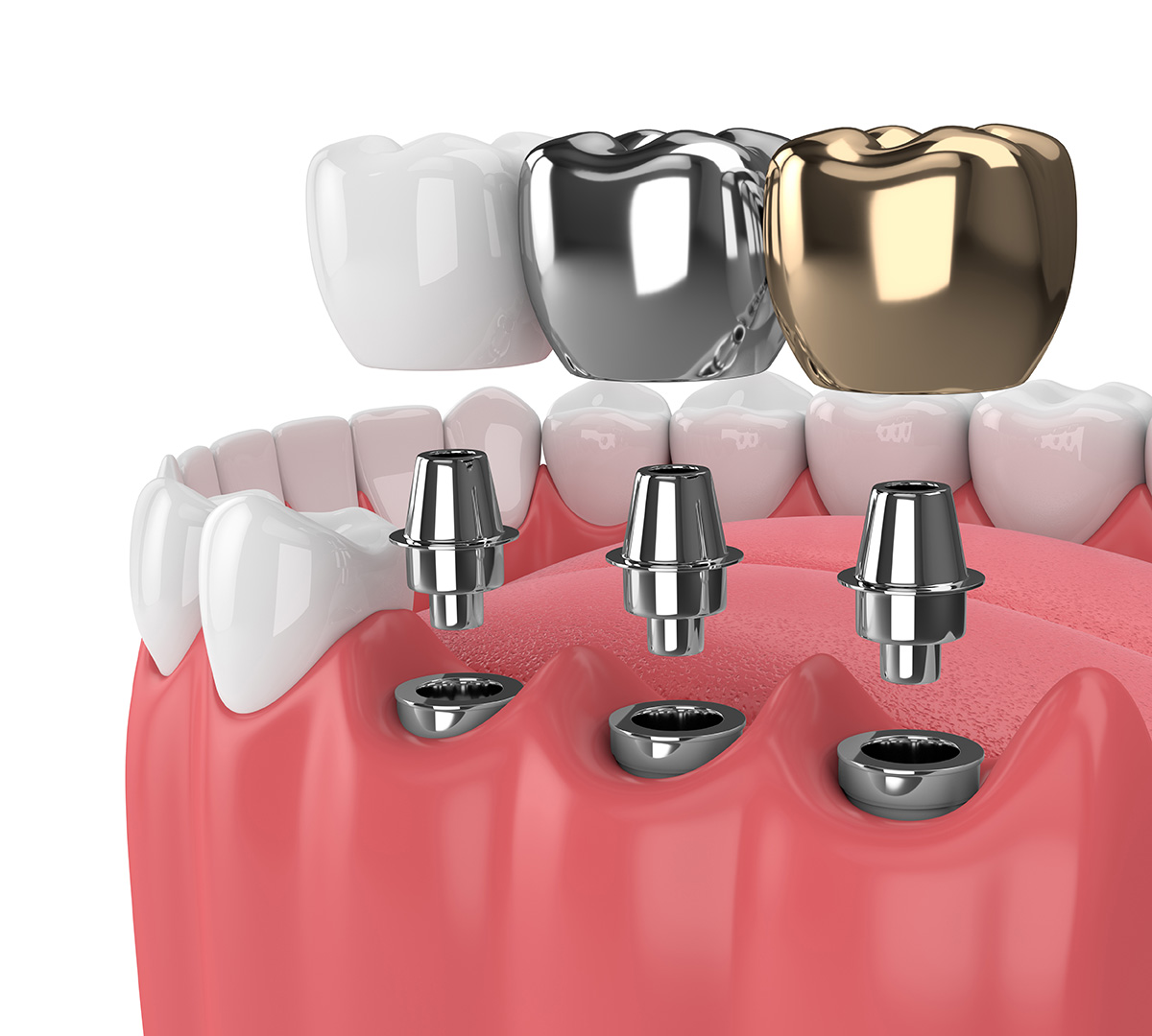 Choosing The Best Type Of Dental Implants For Your Smile