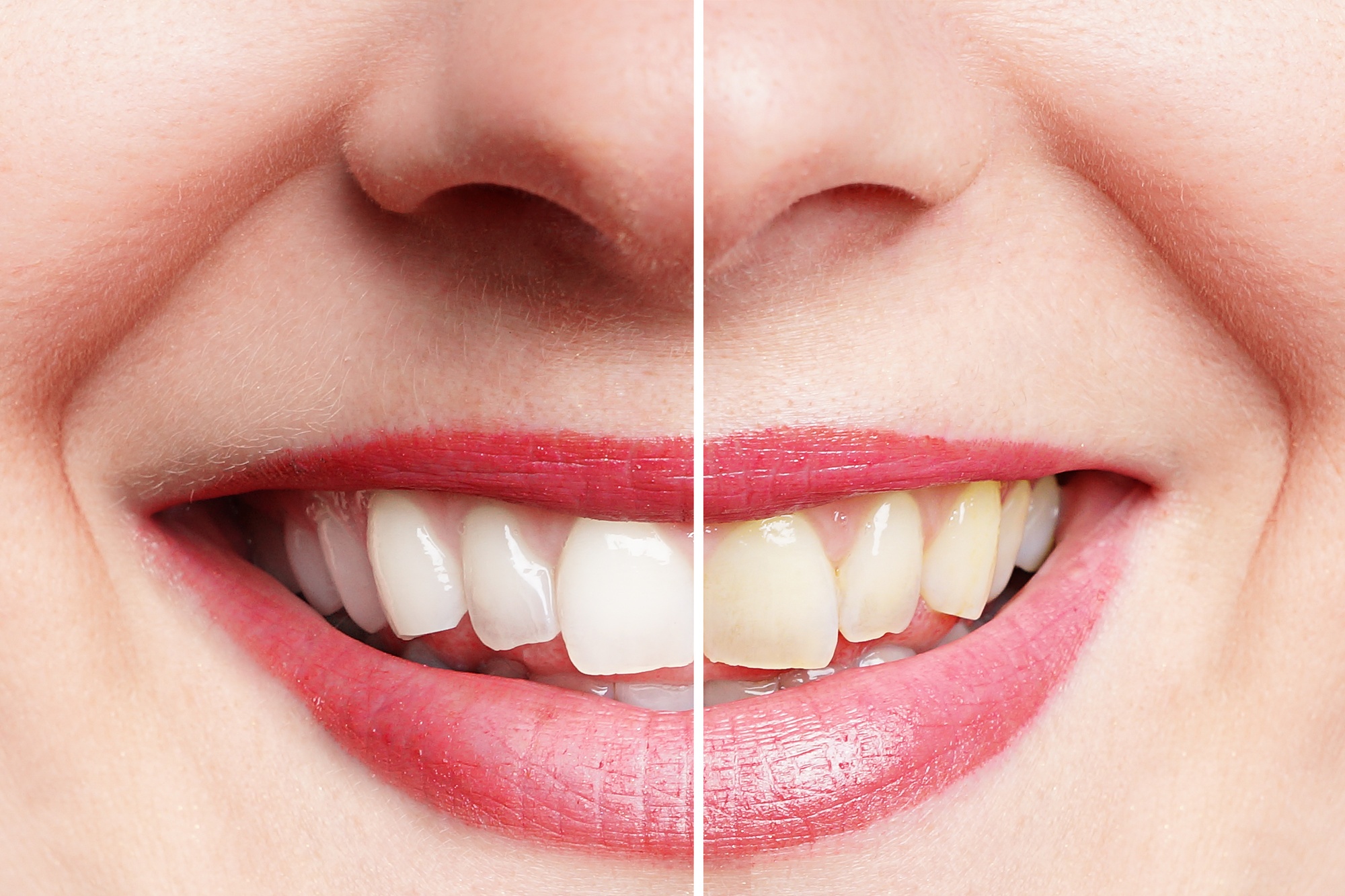 The Best Way To Whiten Teeth: A Dentist’s Guide For 2026