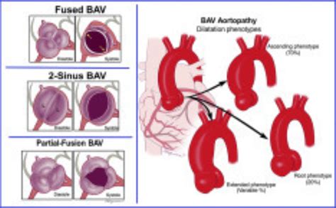 Bicuspid Aortic Valve Life Expectancy