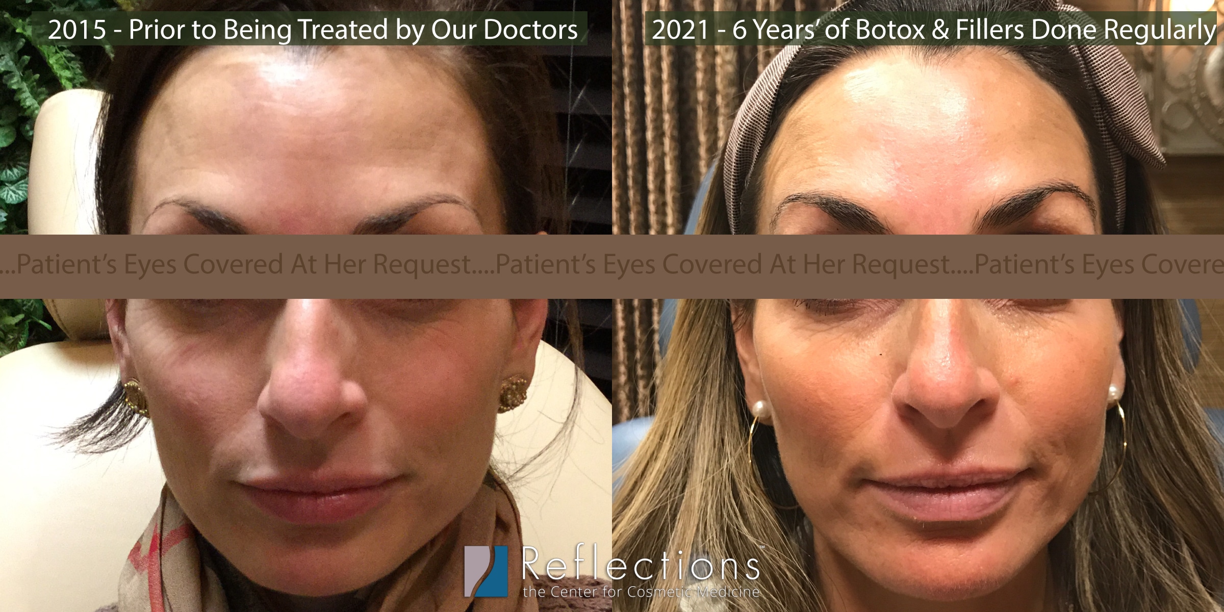 Botox While Pregnant
