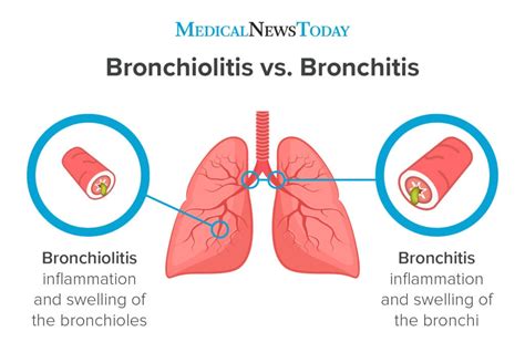Bronchiolitis In Adults
