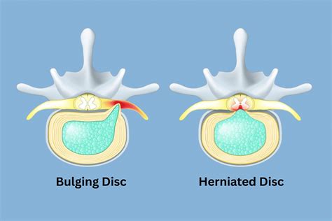 Bulged Disk Vs Herniated