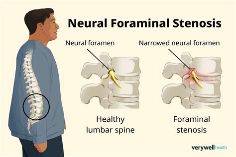 C5c6 Foraminal Stenosis Symptoms