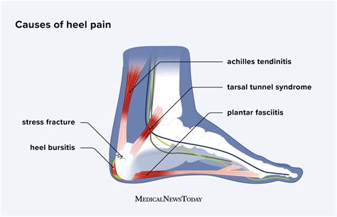 Calcaneus Pain After Running
