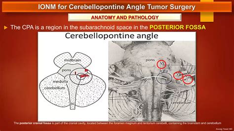 Cerebellopontine Angle Tumor