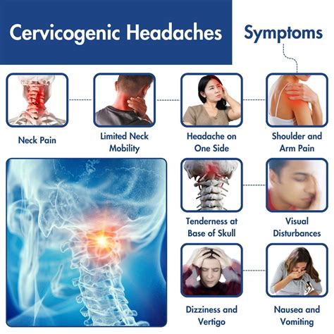 Cervicogenic Migraine Treatment