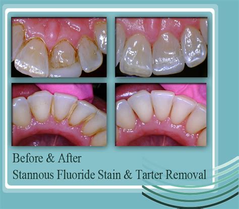 Cetylpyridinium Chloride Does It Stain Teeth