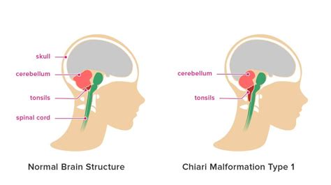 Chiari Malformation Symptoms