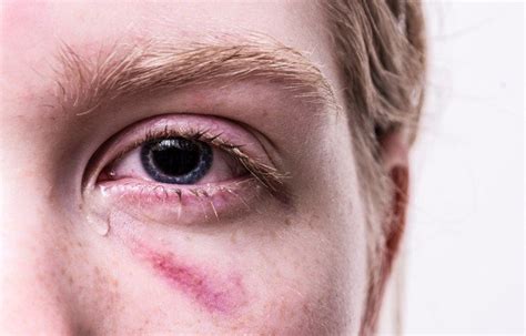 Chipped Eye Socket