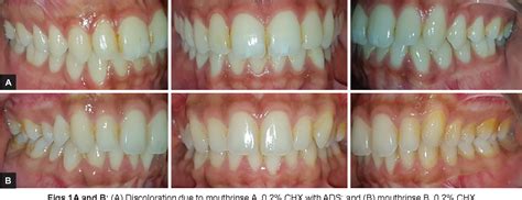 Chlorhexidine Mouthwash Does It Stain Teeth