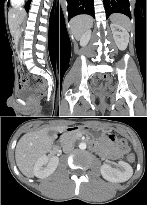 Computed Tomography Abdomen And Pelvis