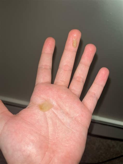Coughed Up Hard Brown Mucus