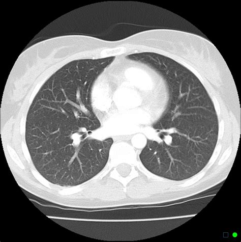 Ct Of Thorax