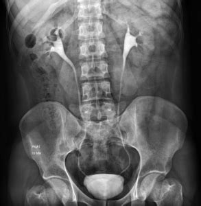 Ct Scan Ivp
