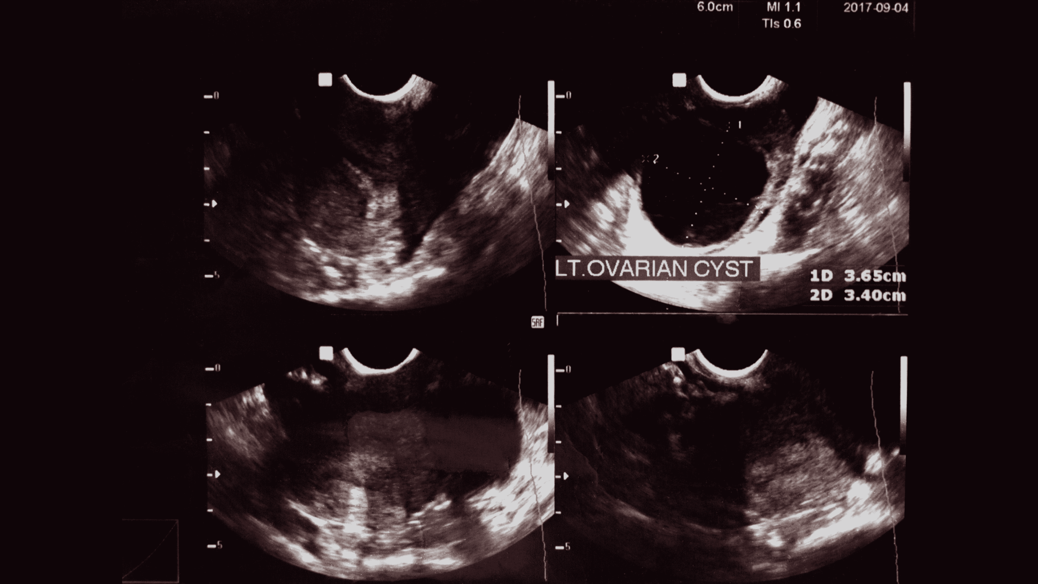 Cyst In Wrist Joint