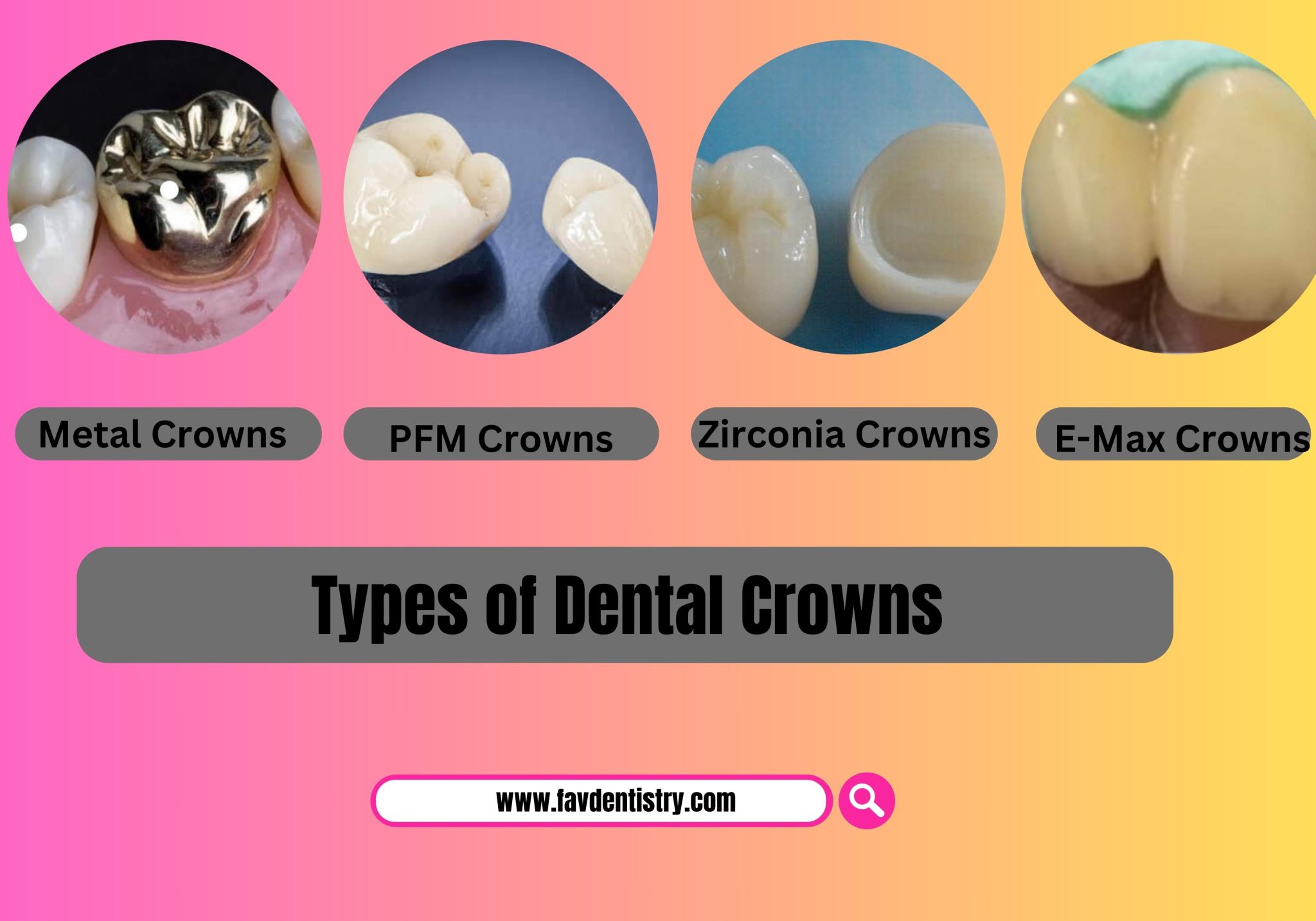 Dental Cap Replacement