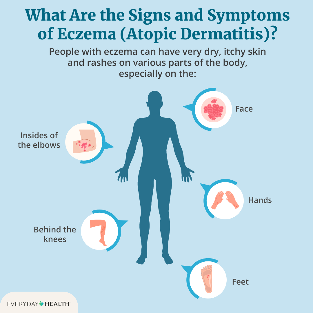 Dermatitis Herpetiformis Remedies