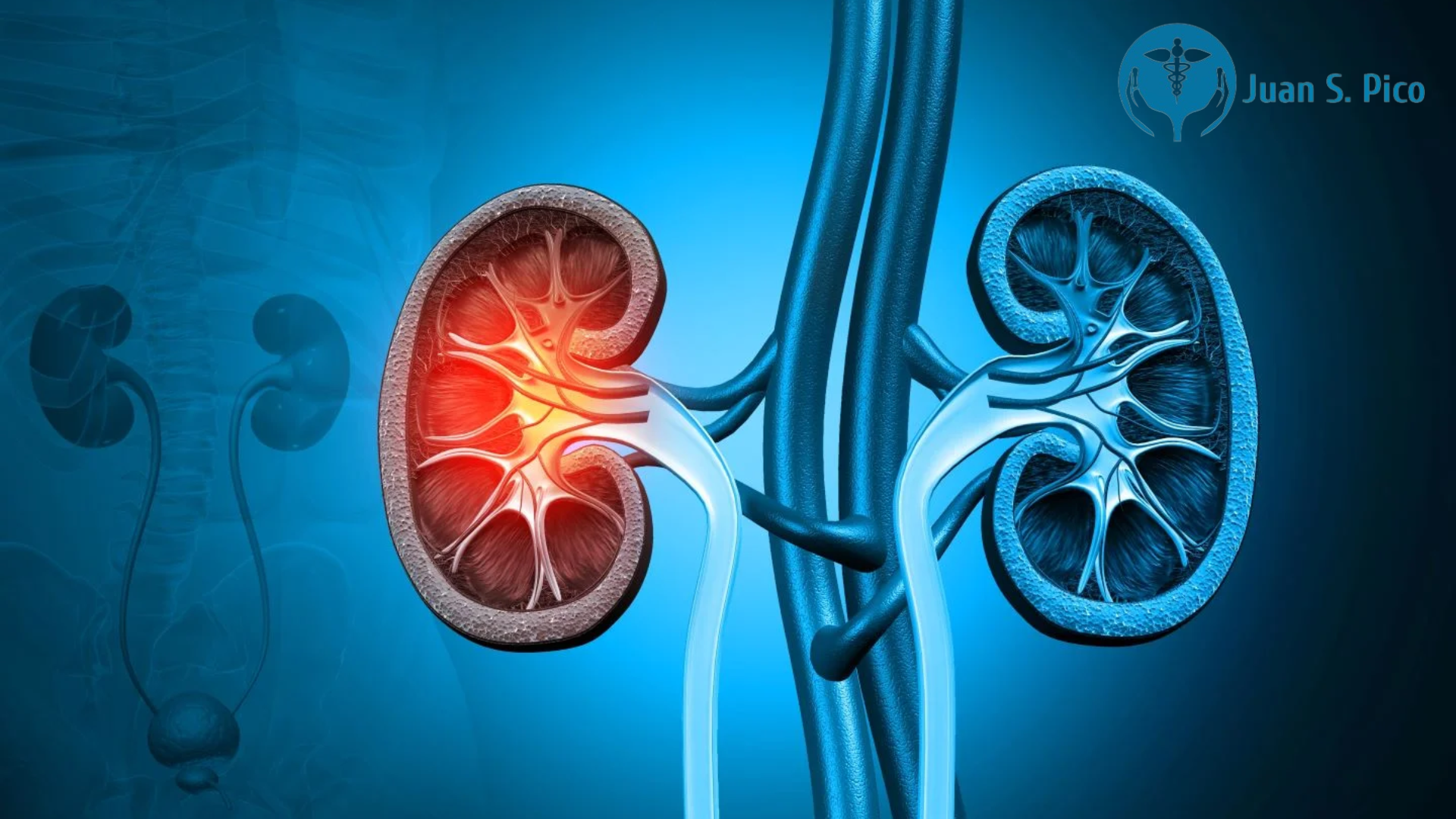Diverticulitis Does It Cause Bleeding