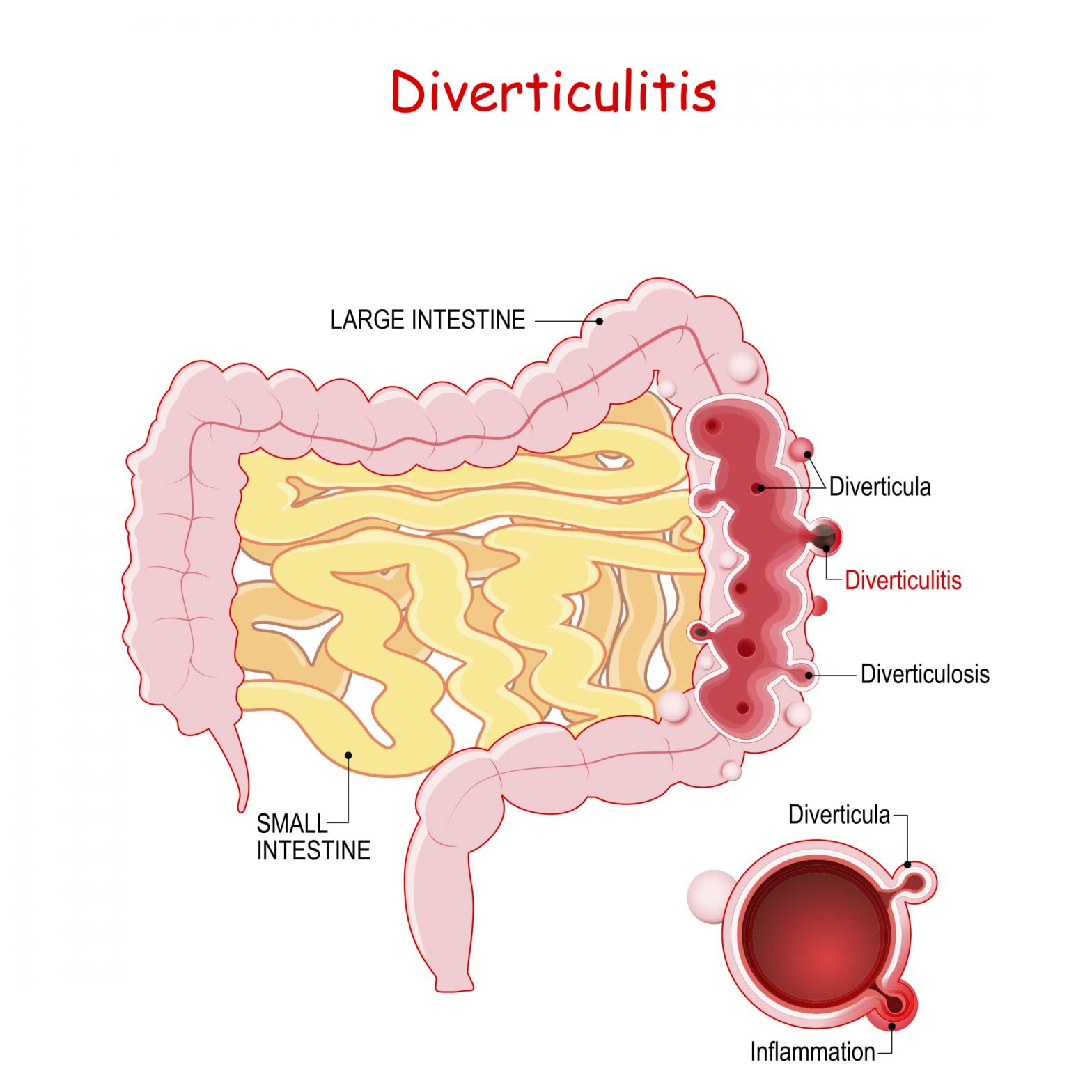 Diverticulitis Foods To Eat