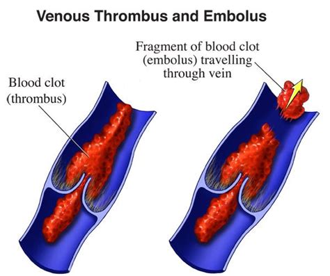 Do Blood Clots Go Away