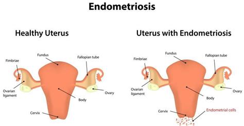 Do Endometriosis Go Away
