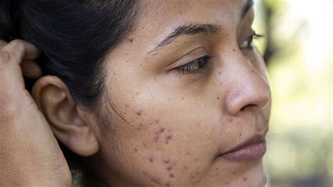 Do Pimple Scars Go Away