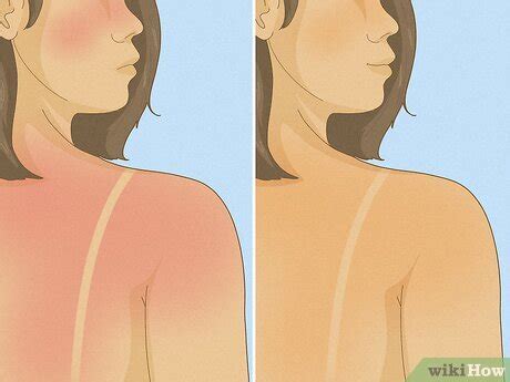 Do Sunburns Turn To Tans