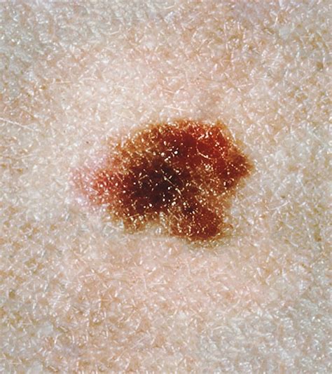Dysplastic Nevus Of Skin