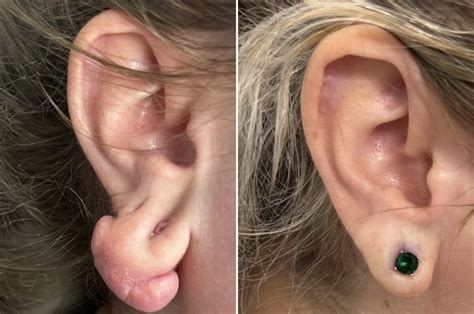 Earlobe Is Swollen