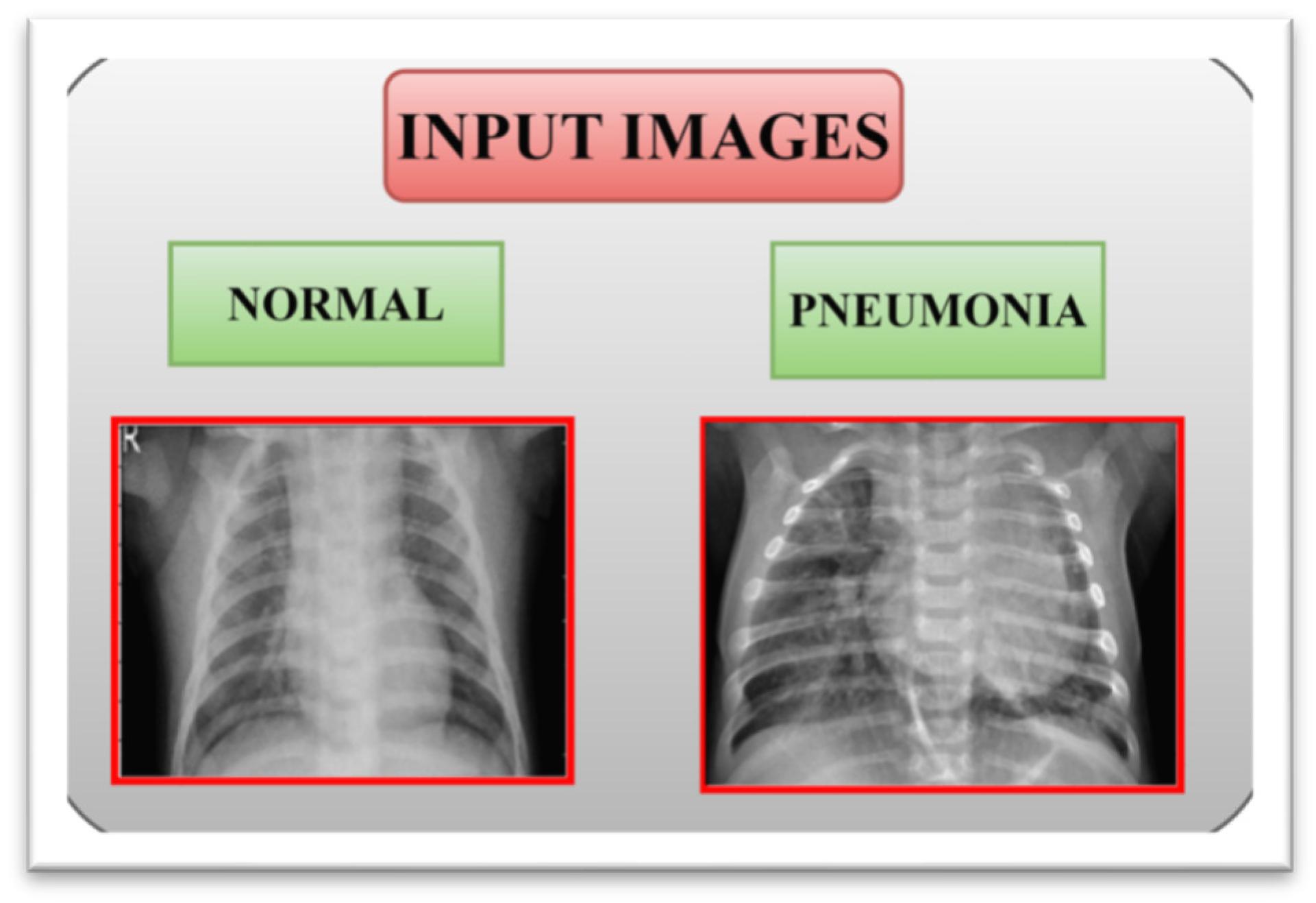 Early Signs Of Pneumonia: What Your Xray Reveals