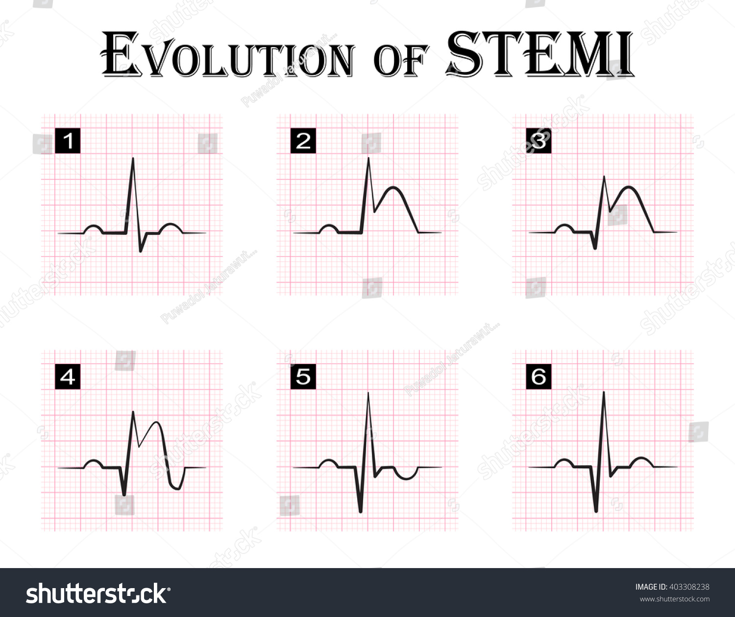 Ecg 12 Lead Test