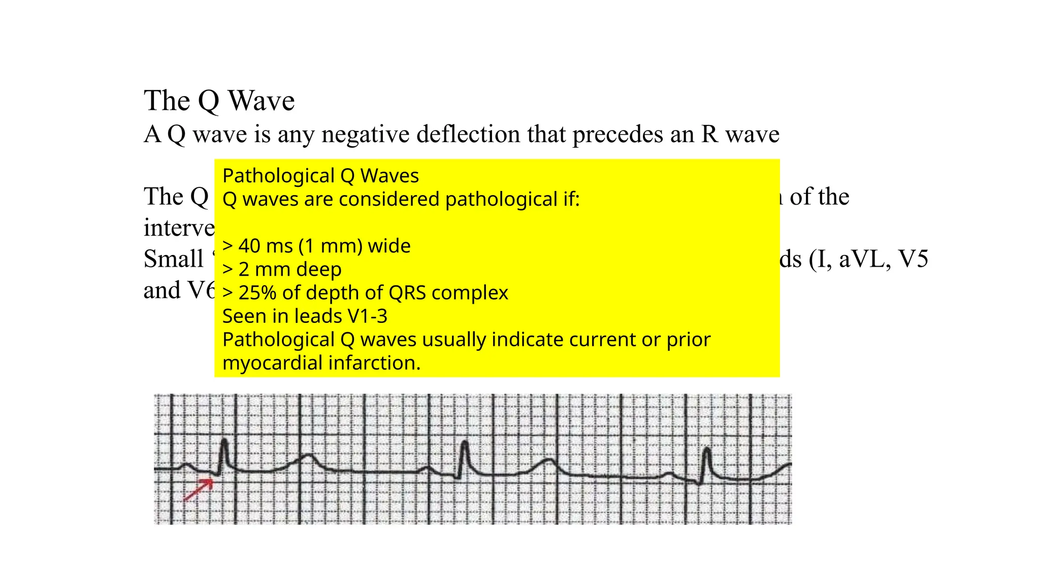 Ecg Watch