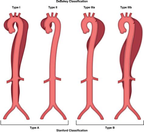 Ectasia Of The Ascending Aorta